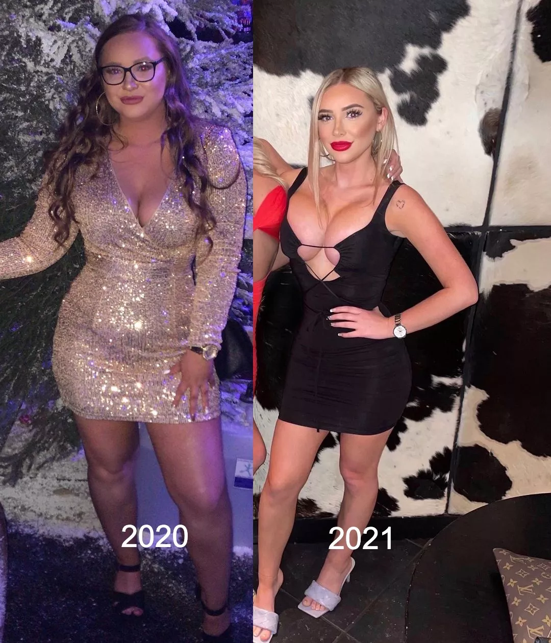 1 year and massive implants 1 year and massive implants
