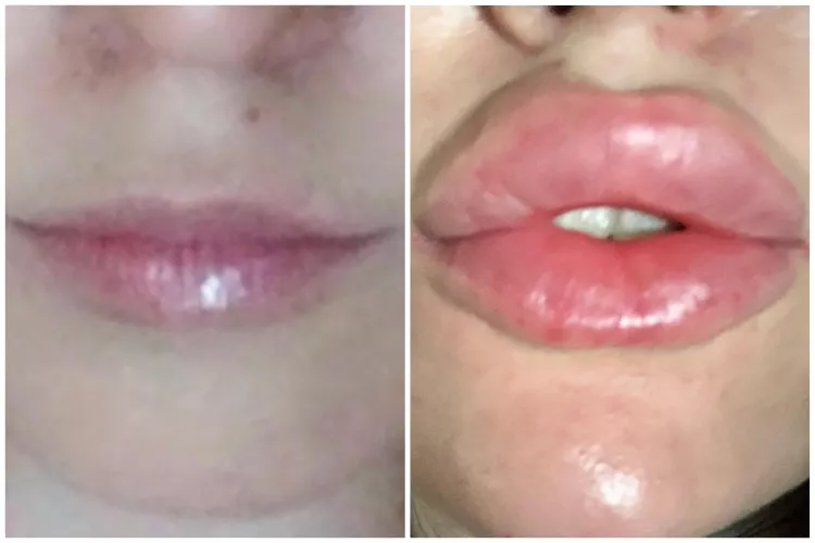 2017-2022 π Freshly injected today, very swollen π