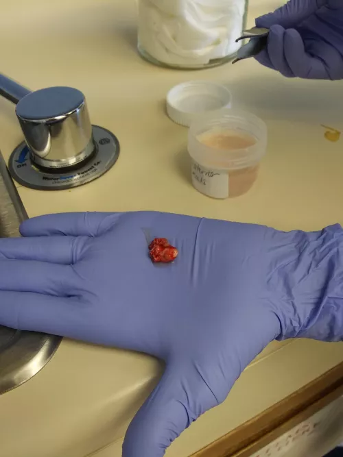 A cyst that was removed from my neck