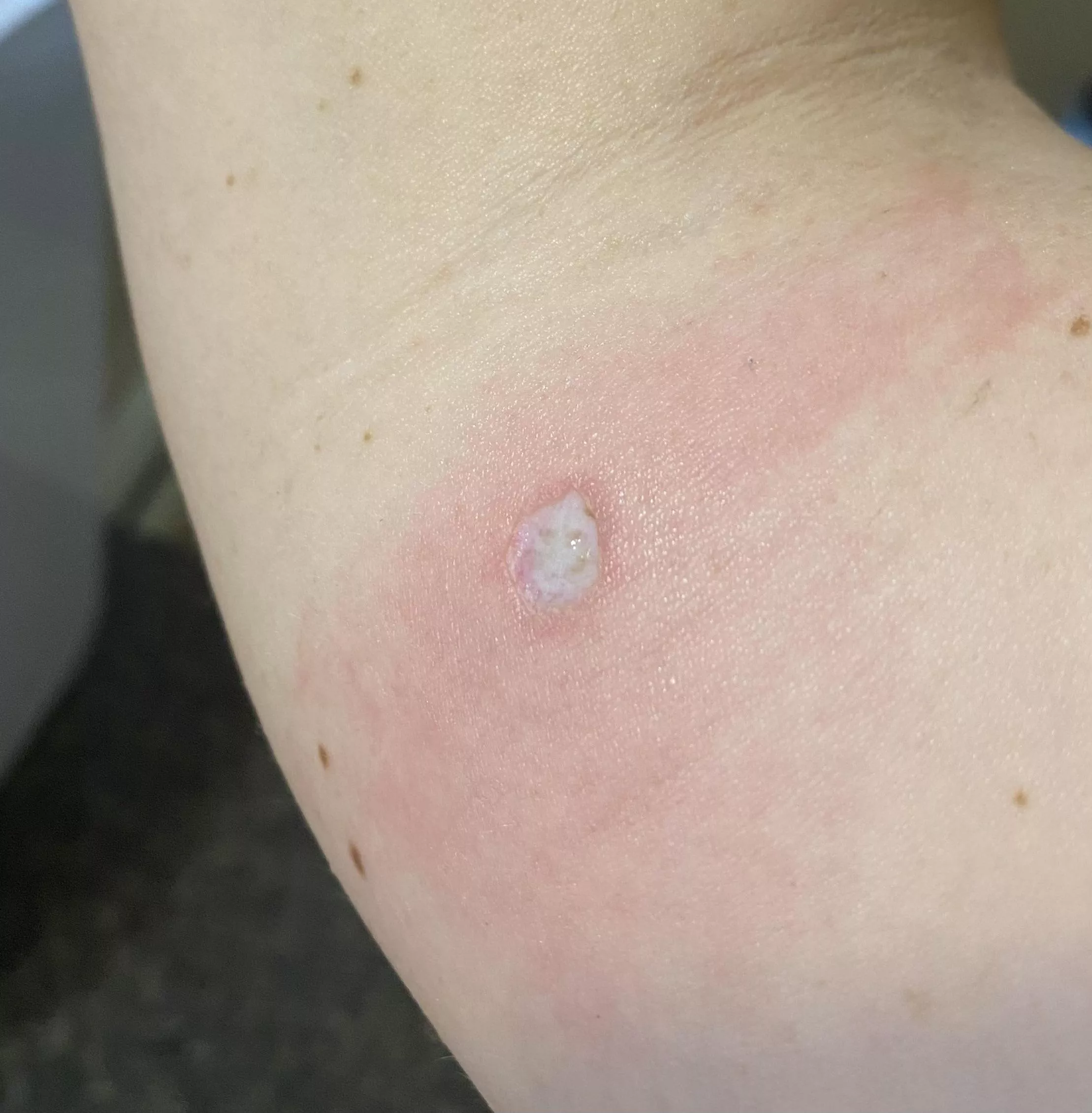 A few days after I had a mole removed for biopsy, and it’s healing up beautifully. Almost in time for spooky szn 🎃