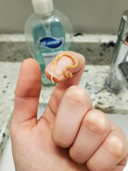 A five year pimple/cyst on my scalp finally came to a head