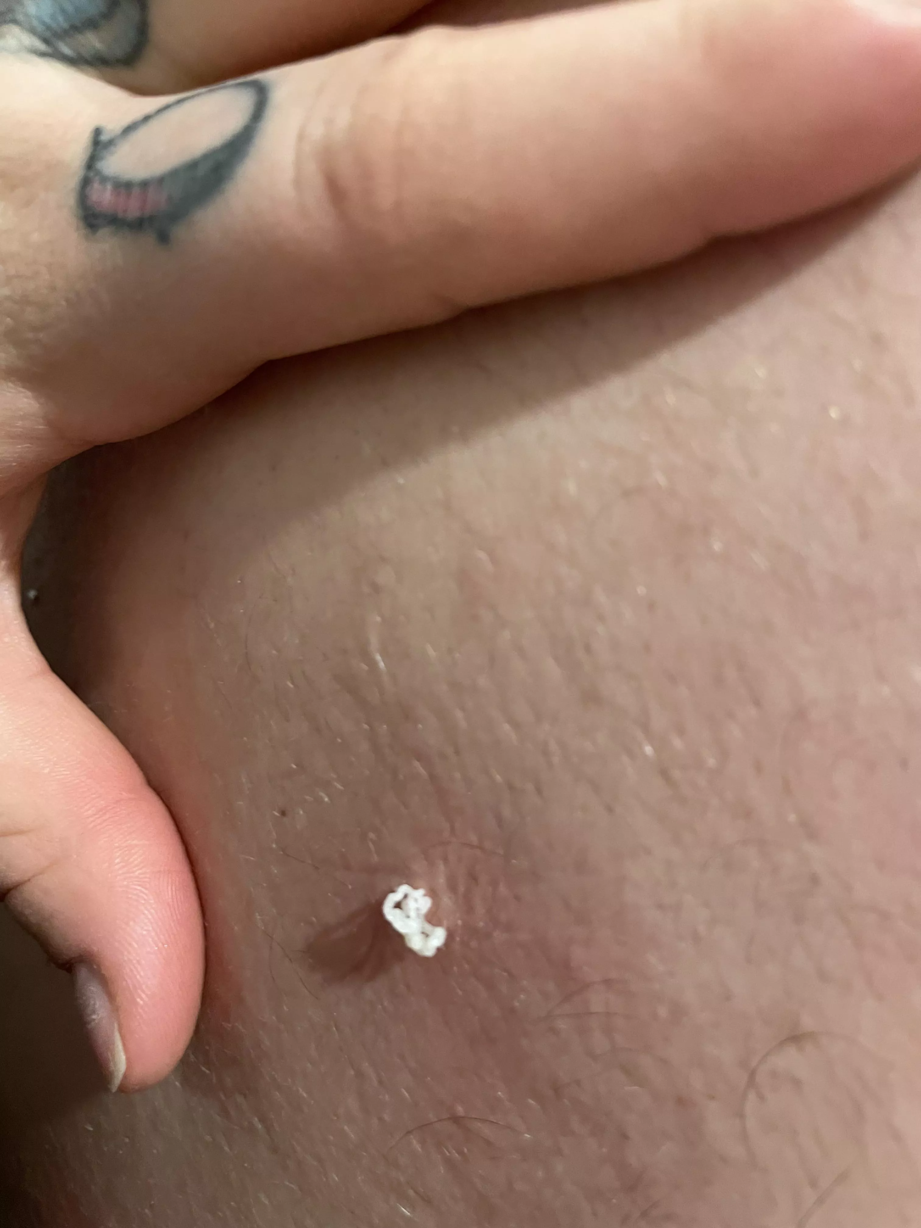 A lil cyst I found on my bfs back