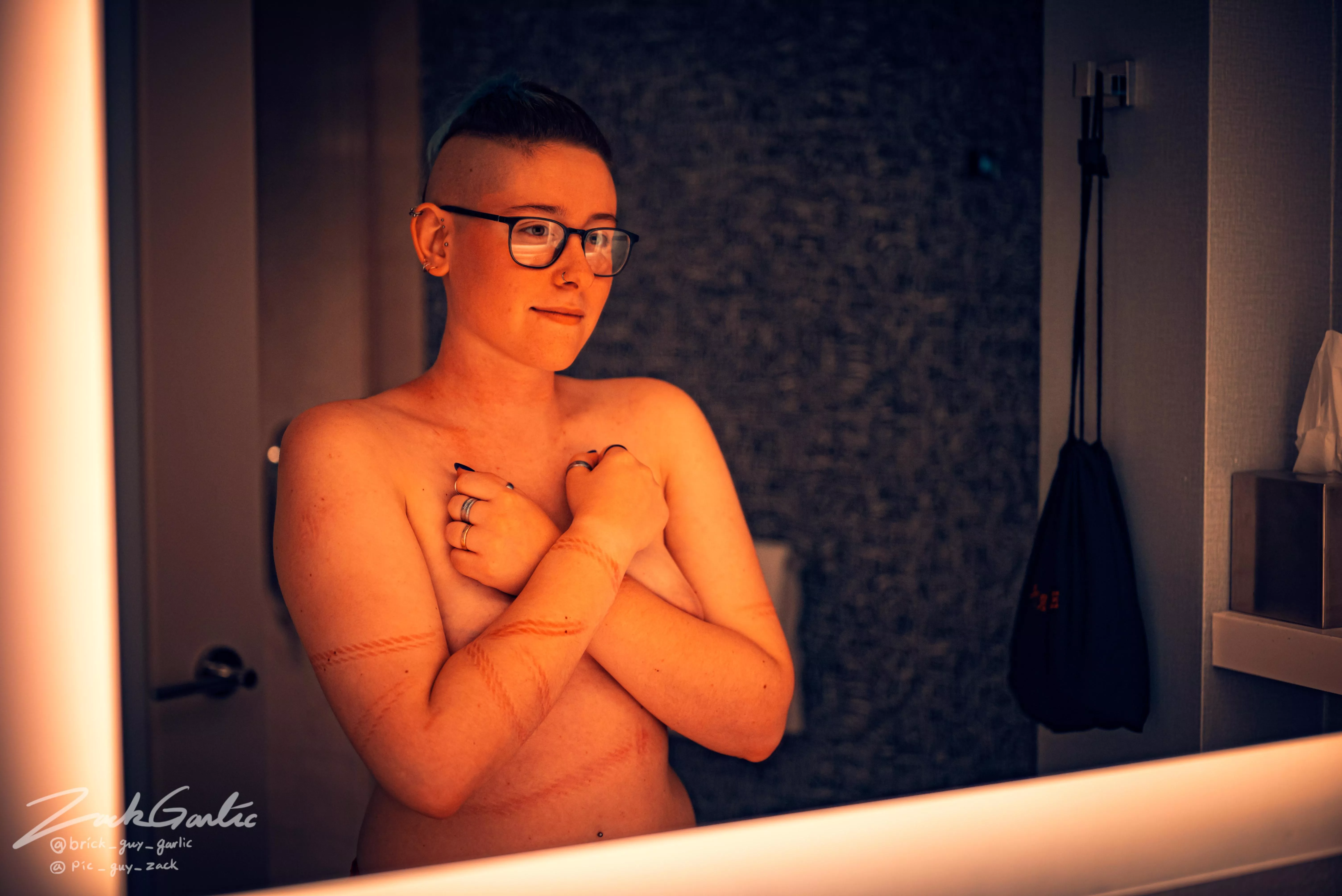 Admiring the burns Admiring the burns