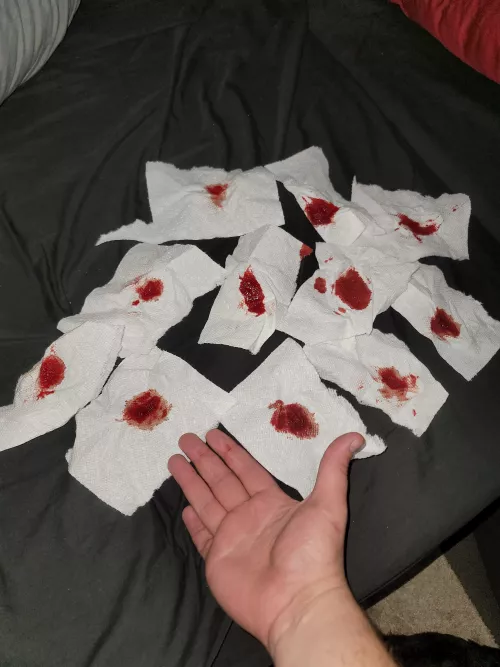 All the blood from a cyst on my ass. It popped a couple weeks ago too and the blood was running down my leg and dripping on the floor. I've never seen so much blood come out of me. Hand for scale
