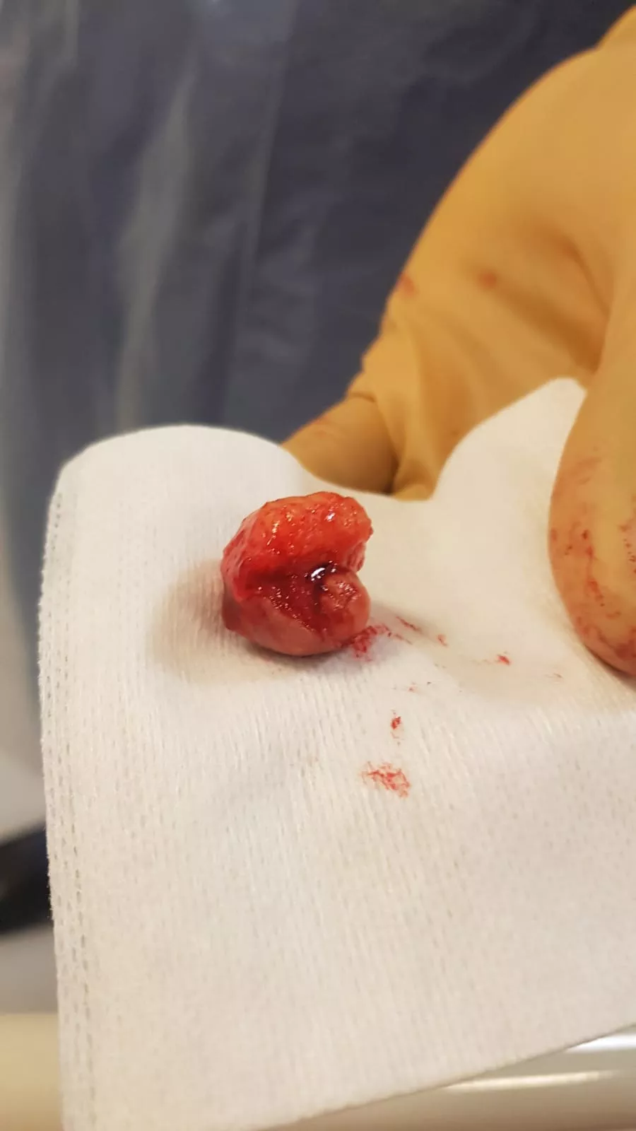 An intact cyst sac removed from my Dad's back today.