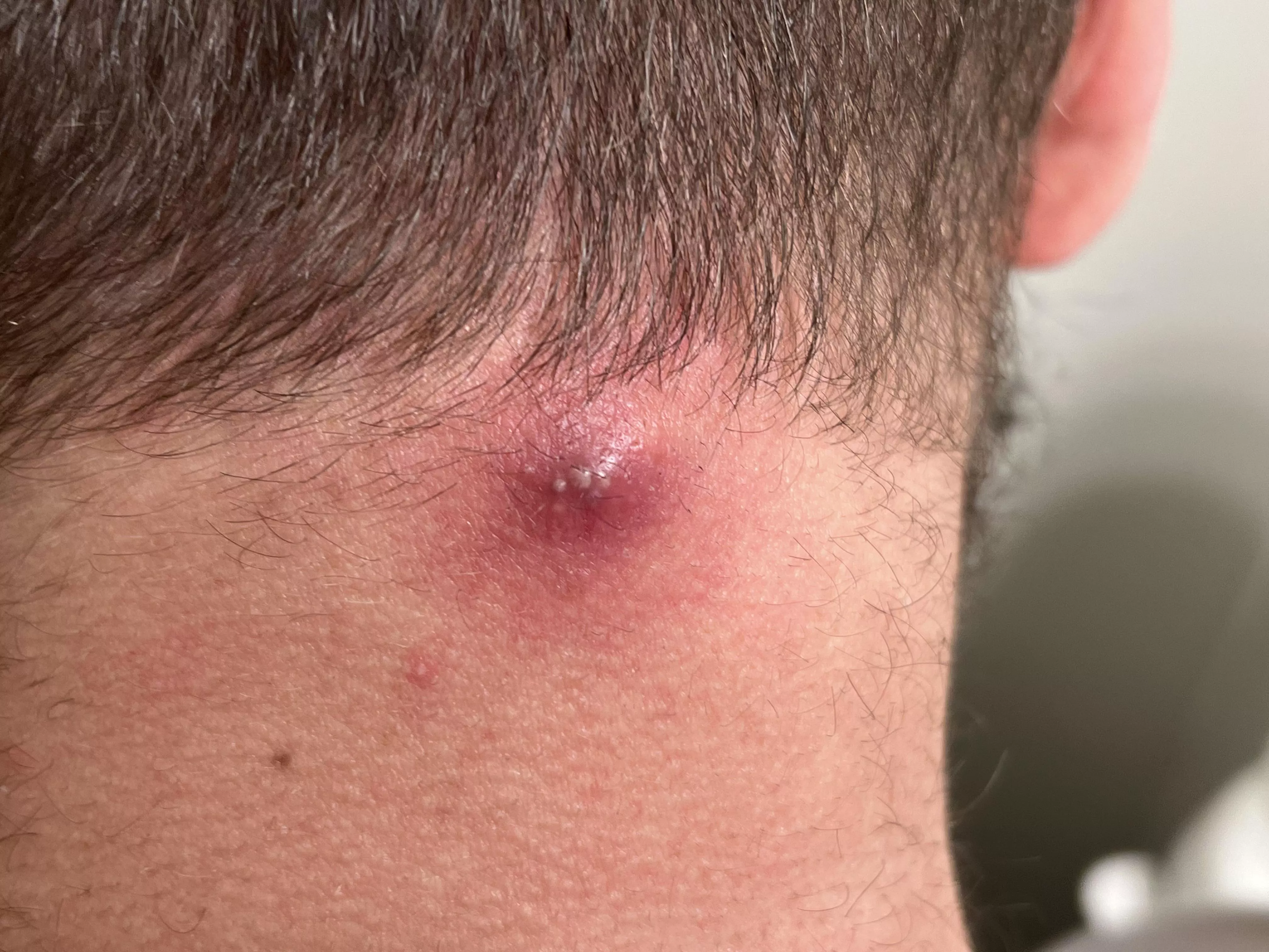 Angry boi on my neck from a year old cyst