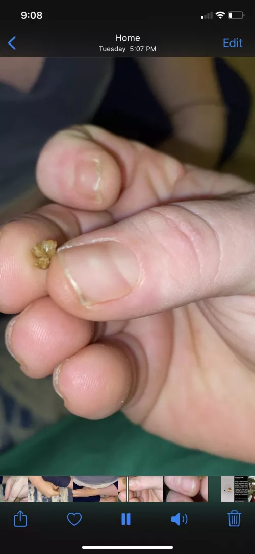 Another kidney stone.