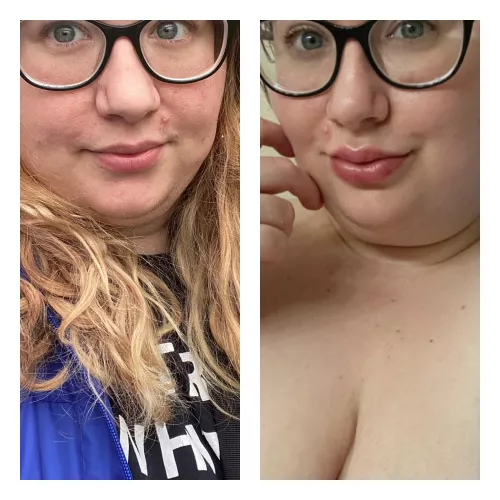 Before and after. First ever lip filler done the other day. I want more