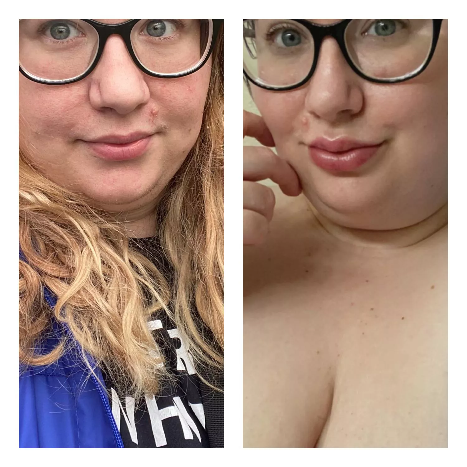 Before and after. First ever lip filler done the other day. I want more