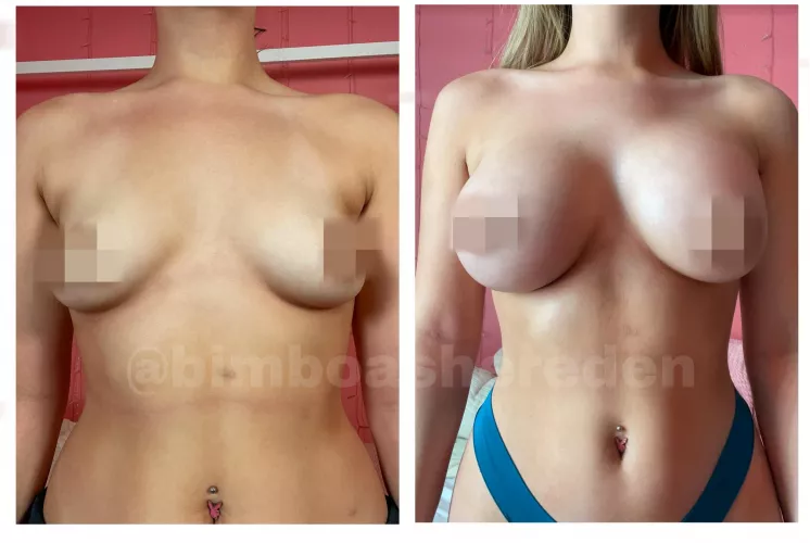 Before/After Boob Job (My Pic, Watermark is Twitter Username!)