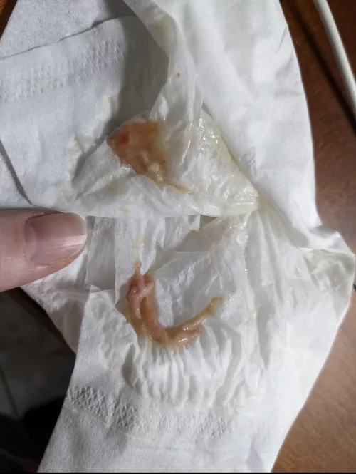 Blew out some nasal polyps this morning. Never had this happened before. Thumb for size. *Note - Already been to the doc - I've got the flu.