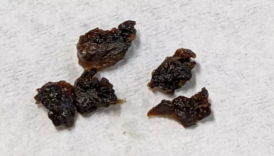 Both ears were full of wax, went to a specialist to get them cleaned out. This was all from the ear with the least severe blockage.