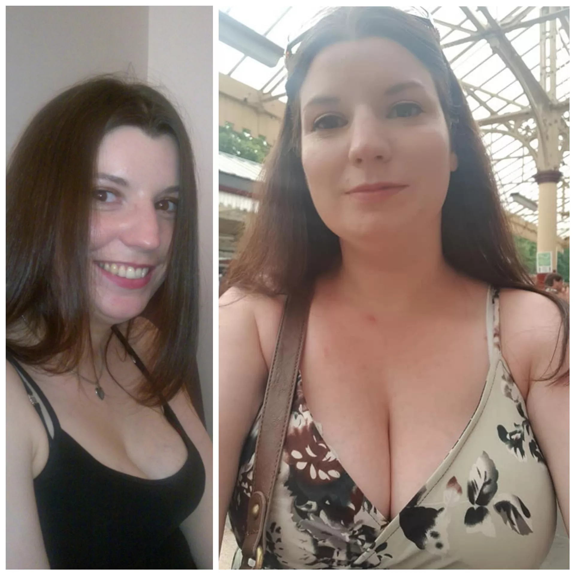 Breast growth post-pregnancy with twins Breast growth post-pregnancy with twins