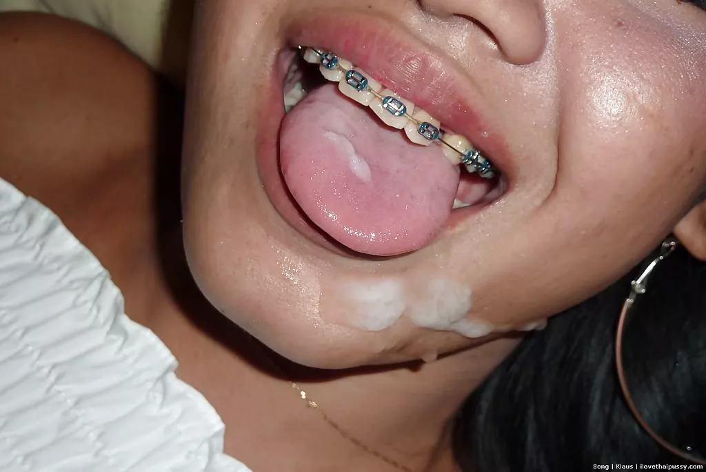 Braces Porn Pics