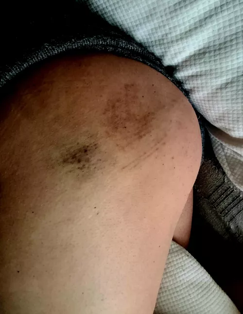 Day 3 of bruising 😈✨ the other butt cheek got at good round of spanking today