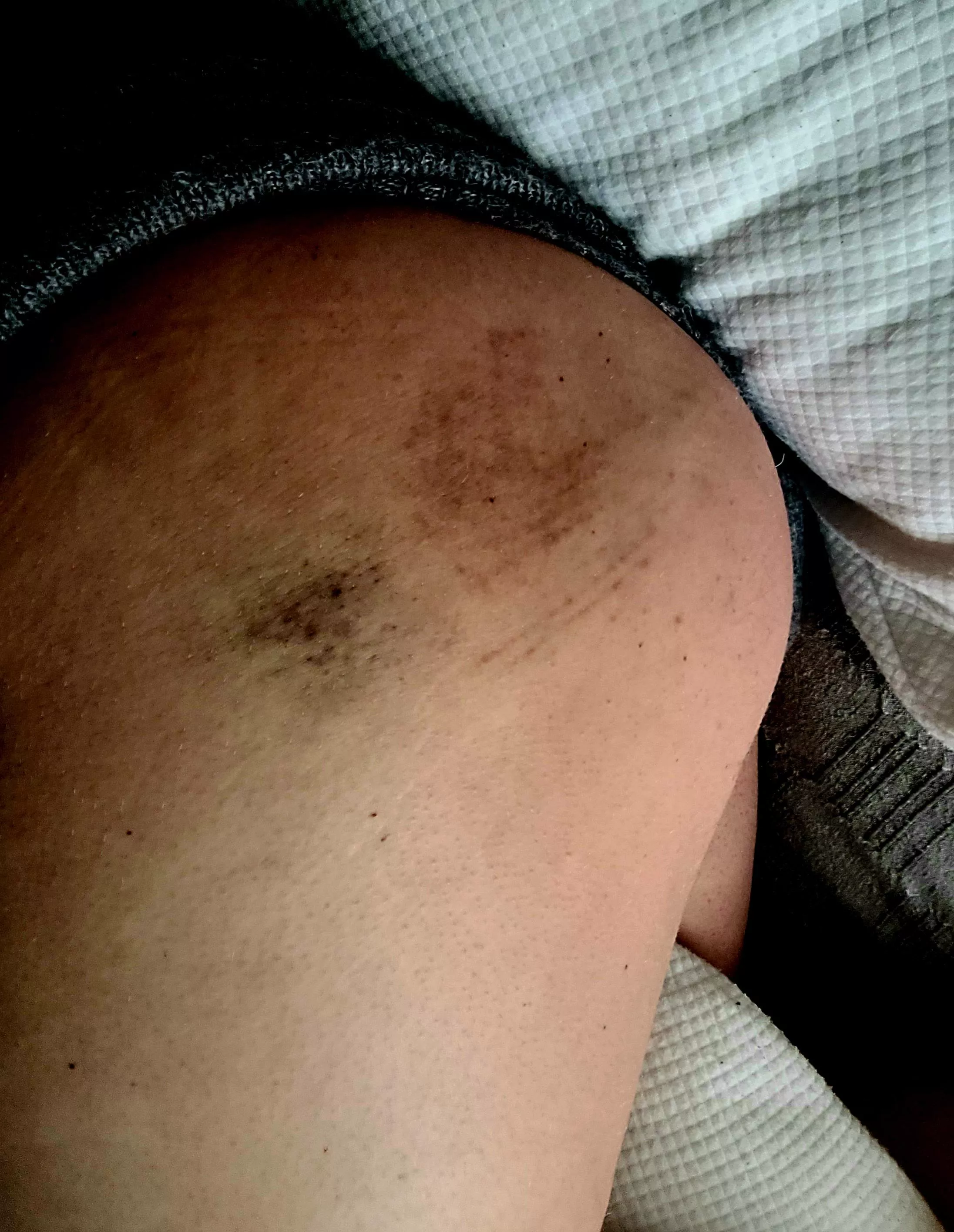 Day 3 of bruising 😈✨ the other butt cheek got at good round of spanking today