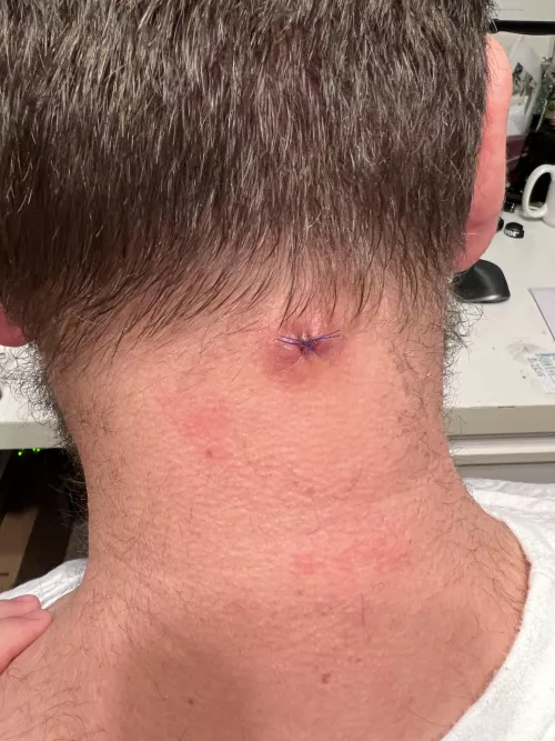 Diagnosis is…folliculitis! (And now I’ve got the stitches\scar to prove it)