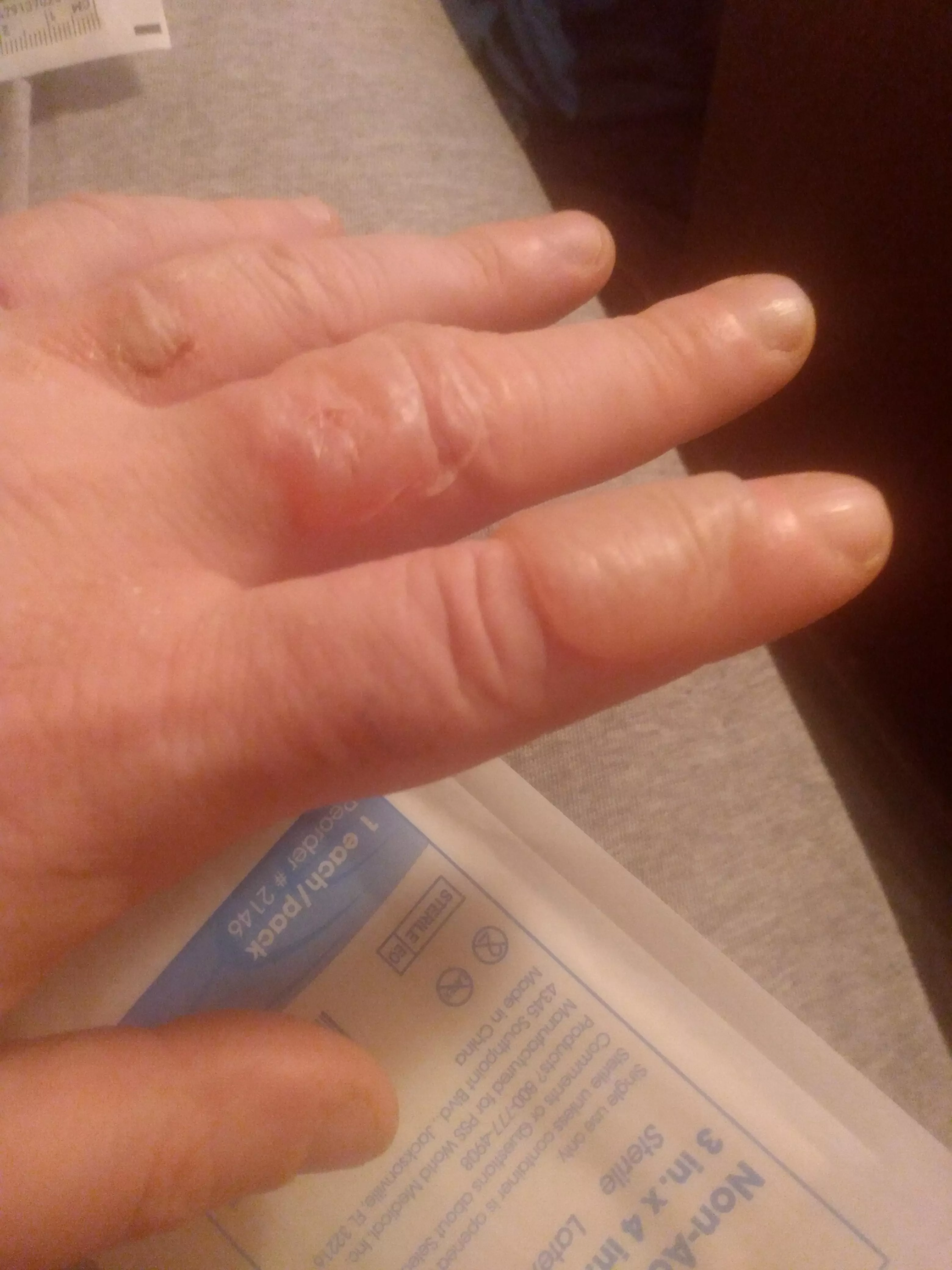 Do hot oil burn blisters belong here? Both fingers already drained. Index is ready for round 2.