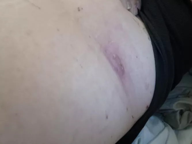 Double headed boil on my back, went to urgent care as it was super angery/ infected and earliest appointment with my derm was February. They lacerated it and drained it. 2 weeks of 2 antibiotics only to realize they didn't even take out the sack. Guess 