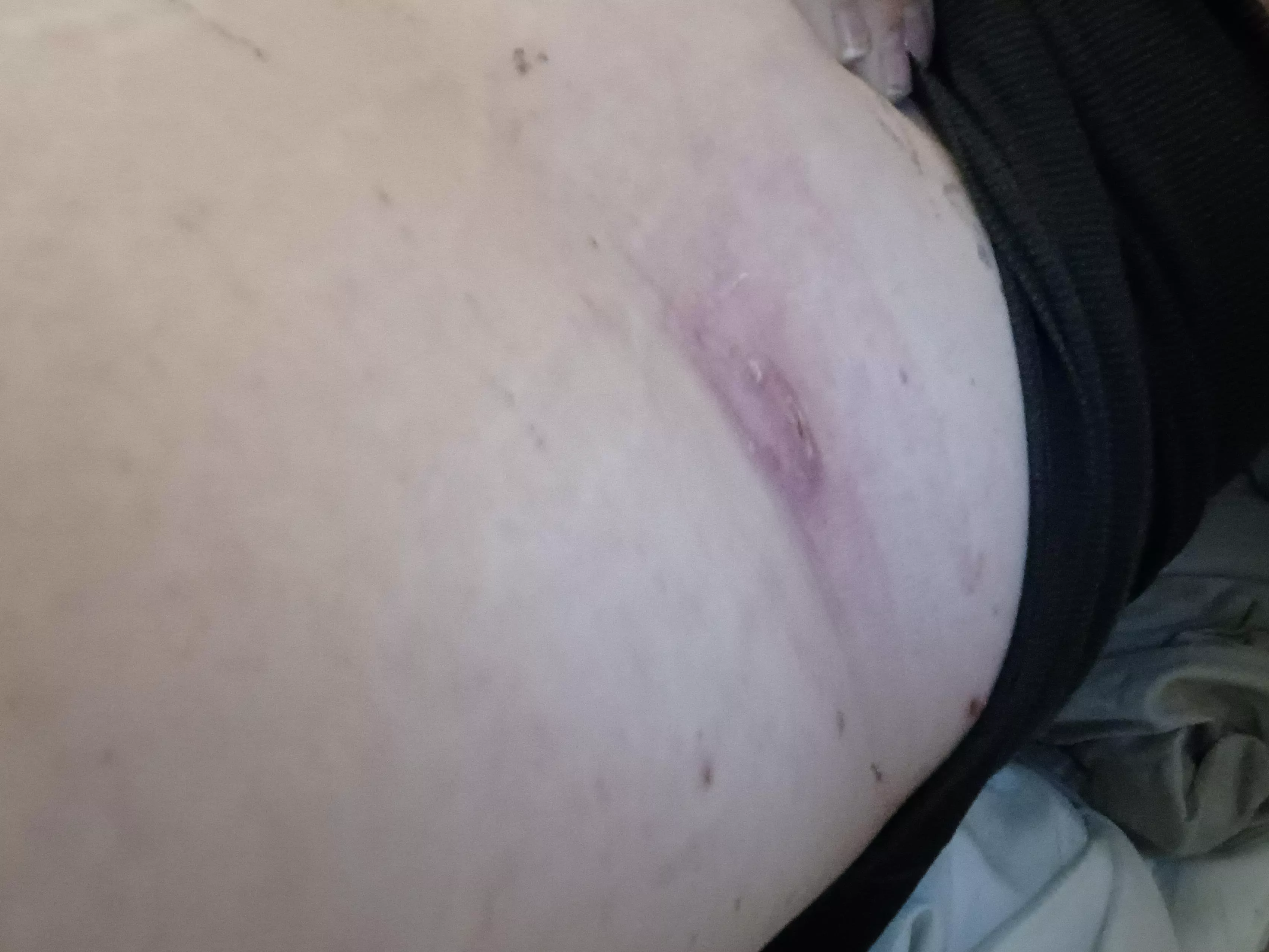 Double headed boil on my back, went to urgent care as it was super angery/ infected and earliest appointment with my derm was February. They lacerated it and drained it. 2 weeks of 2 antibiotics only to realize they didn't even take out the sack. Guess 