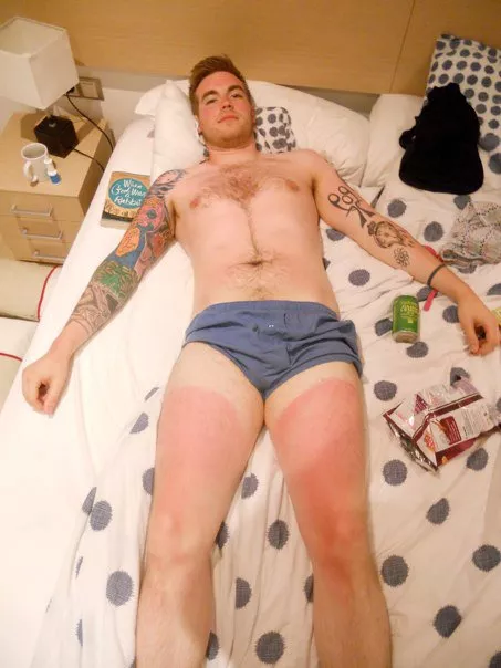 Drunk, sunburnt & stripped down to underwear.