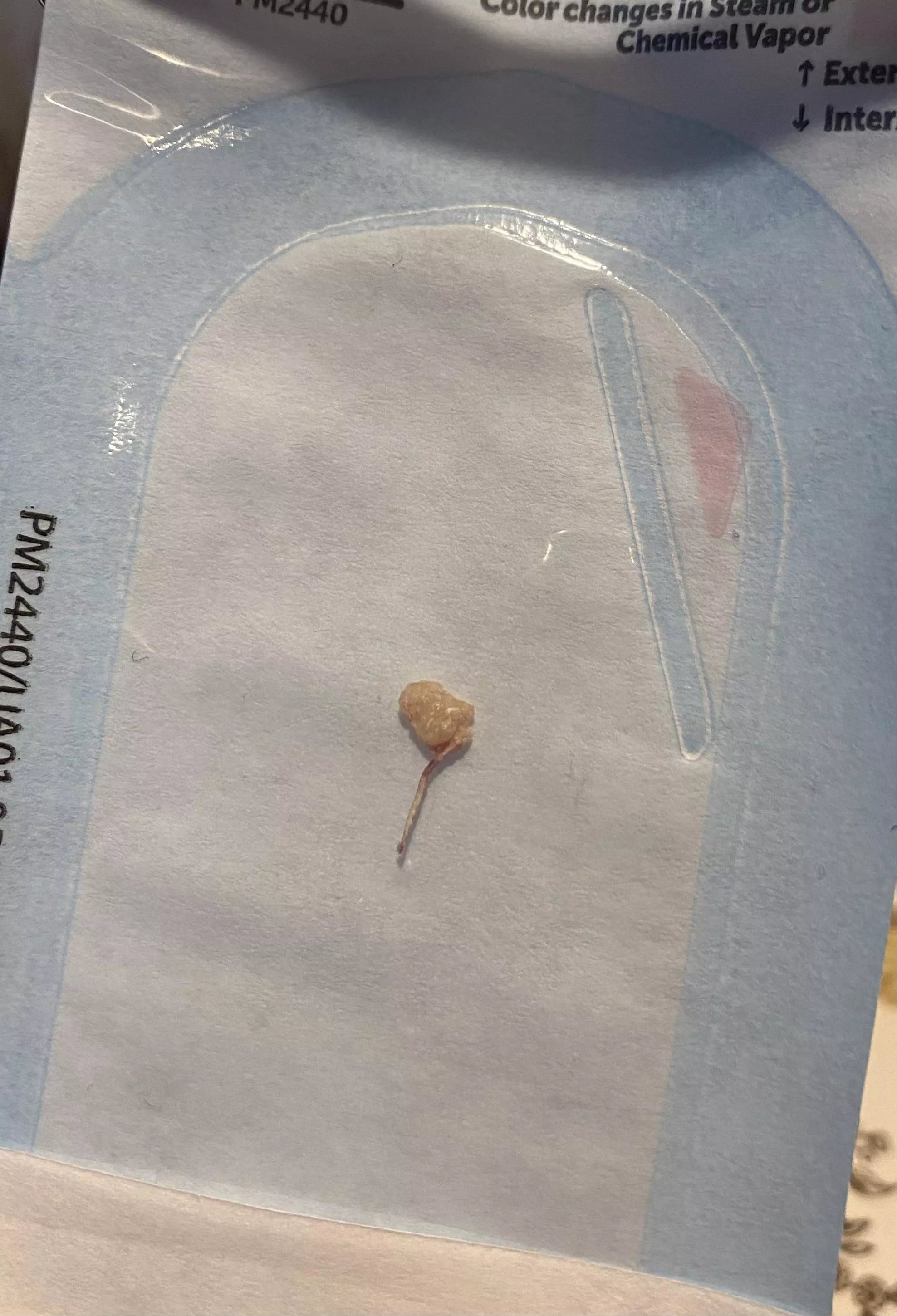 Endolith from tooth #3 root canal