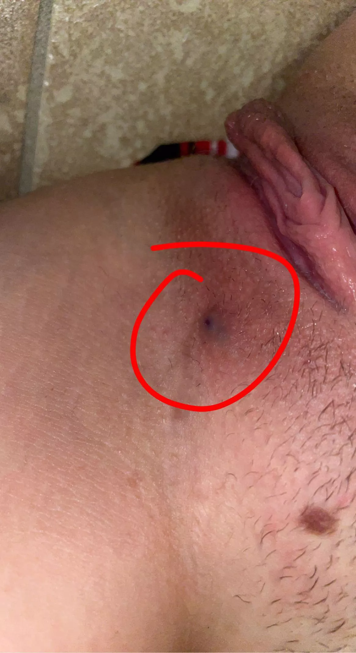 f19 5’5 120lb does anybody know what this is? i’ve been tested and i know im clean but this bump hurts and just won’t go away :/