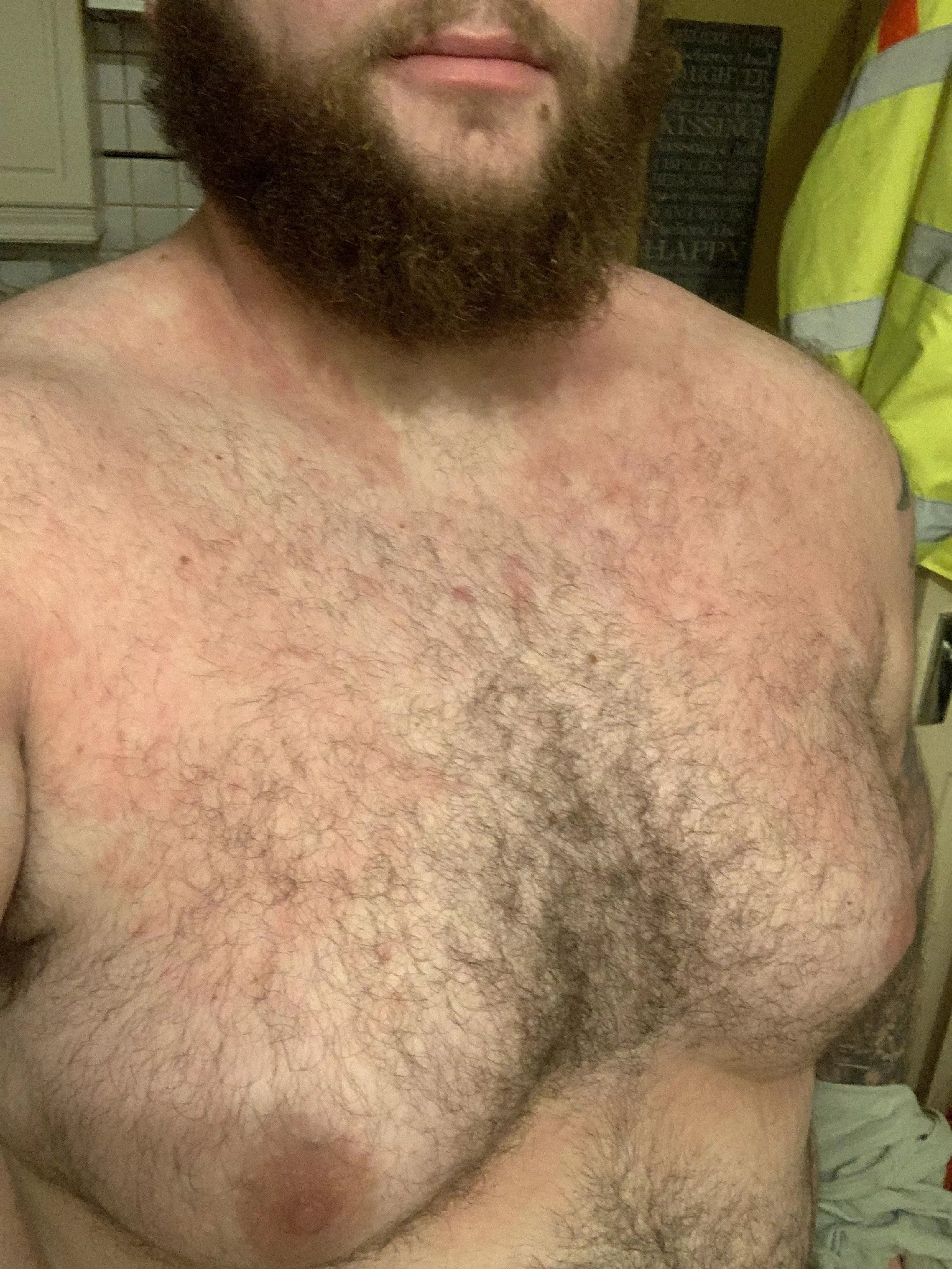 Feeling a little self conscious, had a bad eczema flare up