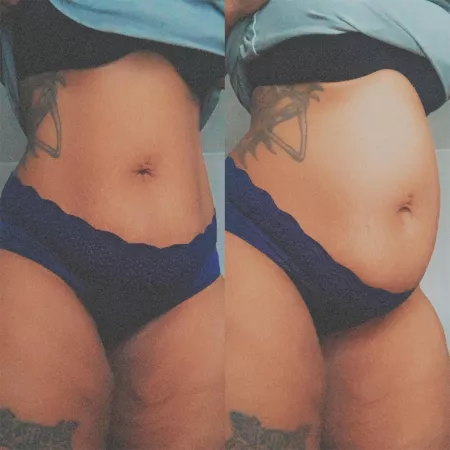 First bloat in years! Hoping to get back to my last max really soon. 😋 First bloat in years! Hoping to get back to my last max really soon. 😋