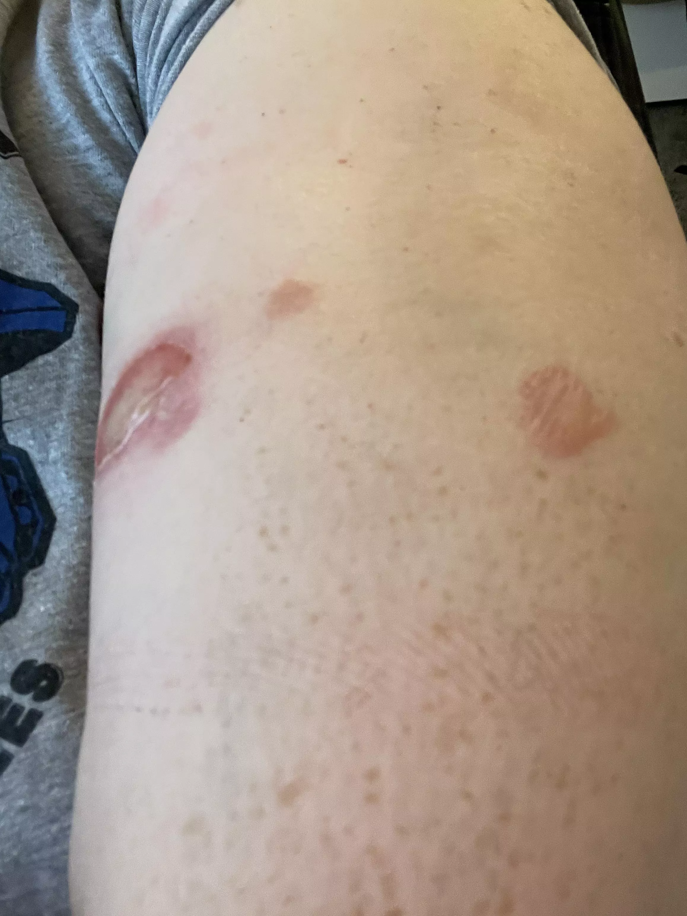 (First post/OC) Forbidden pops! Burns from boiling water, just removed the dressings