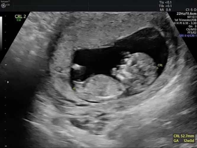 #First Pregnancy scan.. Sharing my wife's first pregnancy scan report to all the beloved users here. Her bull impregnated her on December and she is now carrying his seed. I am truly excited to get this first scan report.. Dream come true moments of my