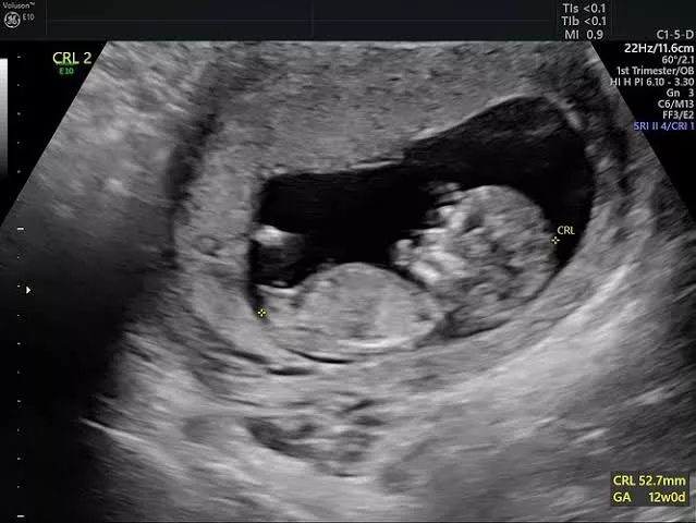 #First Pregnancy scan.. Sharing my wife's first pregnancy scan report to all the beloved users here. Her bull impregnated her on December and she is now carrying his seed. I am truly excited to get this first scan report.. Dream come true moments of my  #First Pregnancy scan.. Sharing my wife's first pregnancy scan report to all the beloved users here. Her bull impregnated her on December and she is now carrying his seed. I am truly excited to get this first scan report.. Dream come true moments of my