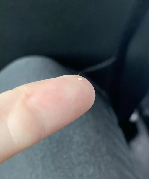 First time posting. Got this little guy out of my shoulder. You can just see the hair in it.