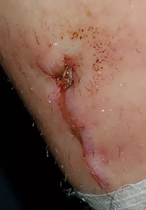 Forbidden pop. Had surgery last wk. Wrist area. It is so hard not to touch now that it's uncovered.