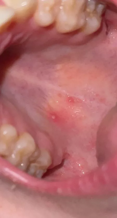 Forbidden pops in my mouth. Oral herpes flaring up