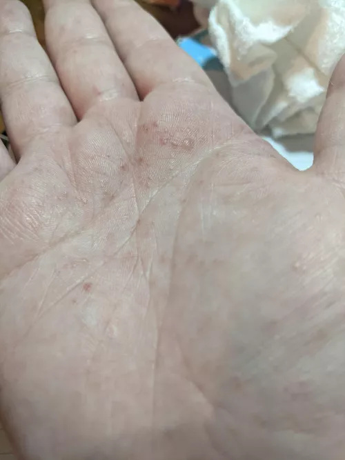 Forbidden pops in the form of Pompholyx Eczema, both my palms and sokes of my feet are covered, the itching is torture 😭