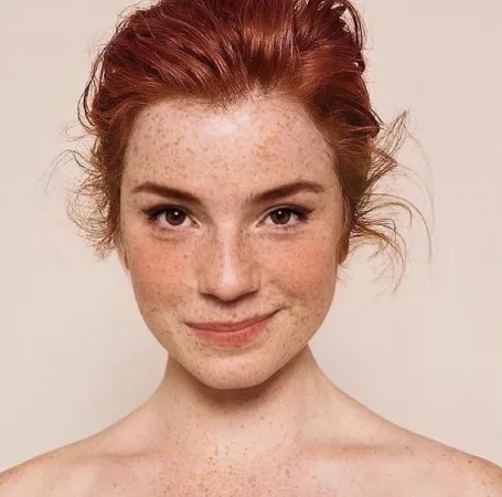 Freckles. Freckles.