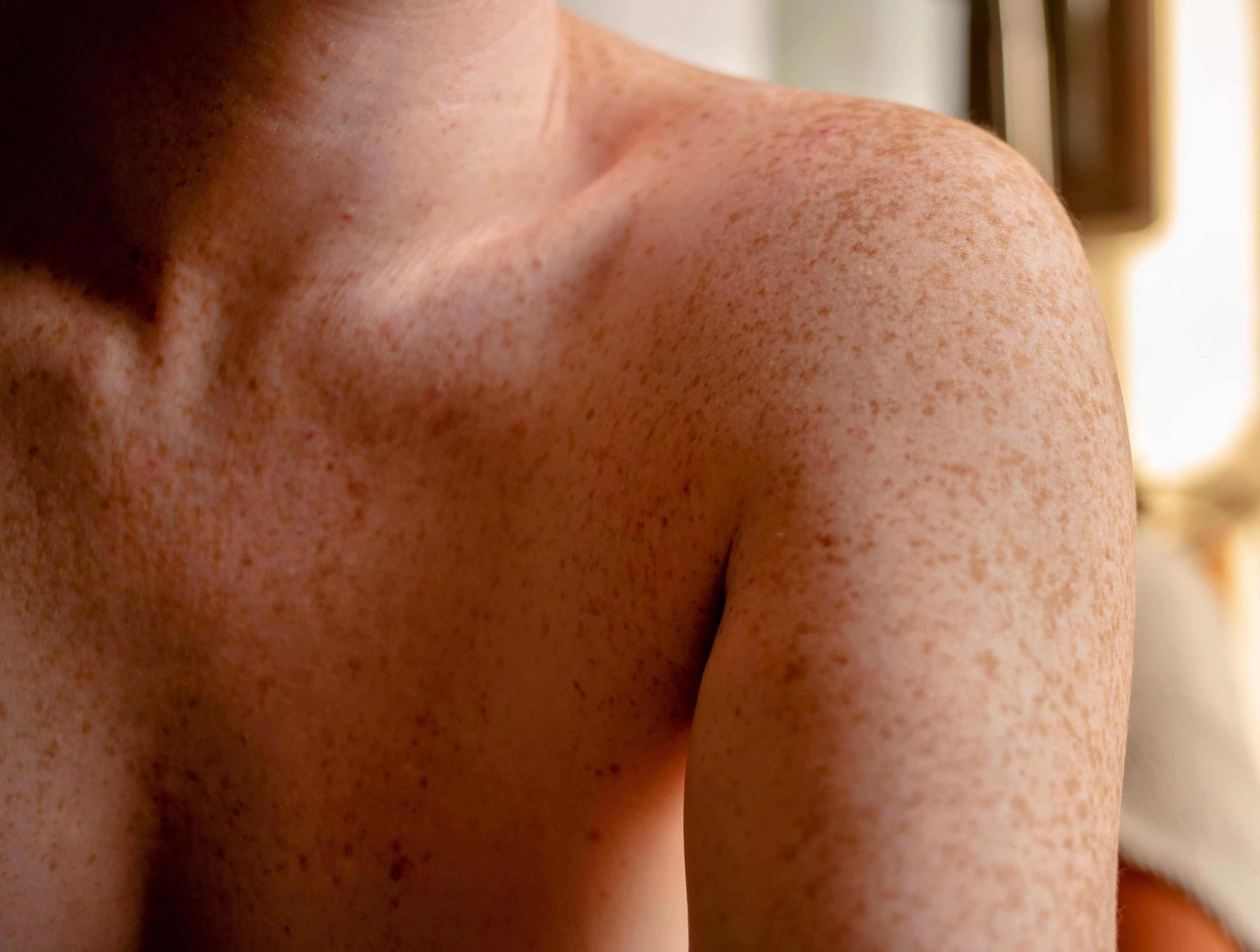 Fun Fact: ephelides (or ephelis) is the medical/greek term for freckles. Fun Fact: ephelides (or ephelis) is the medical/greek term for freckles.