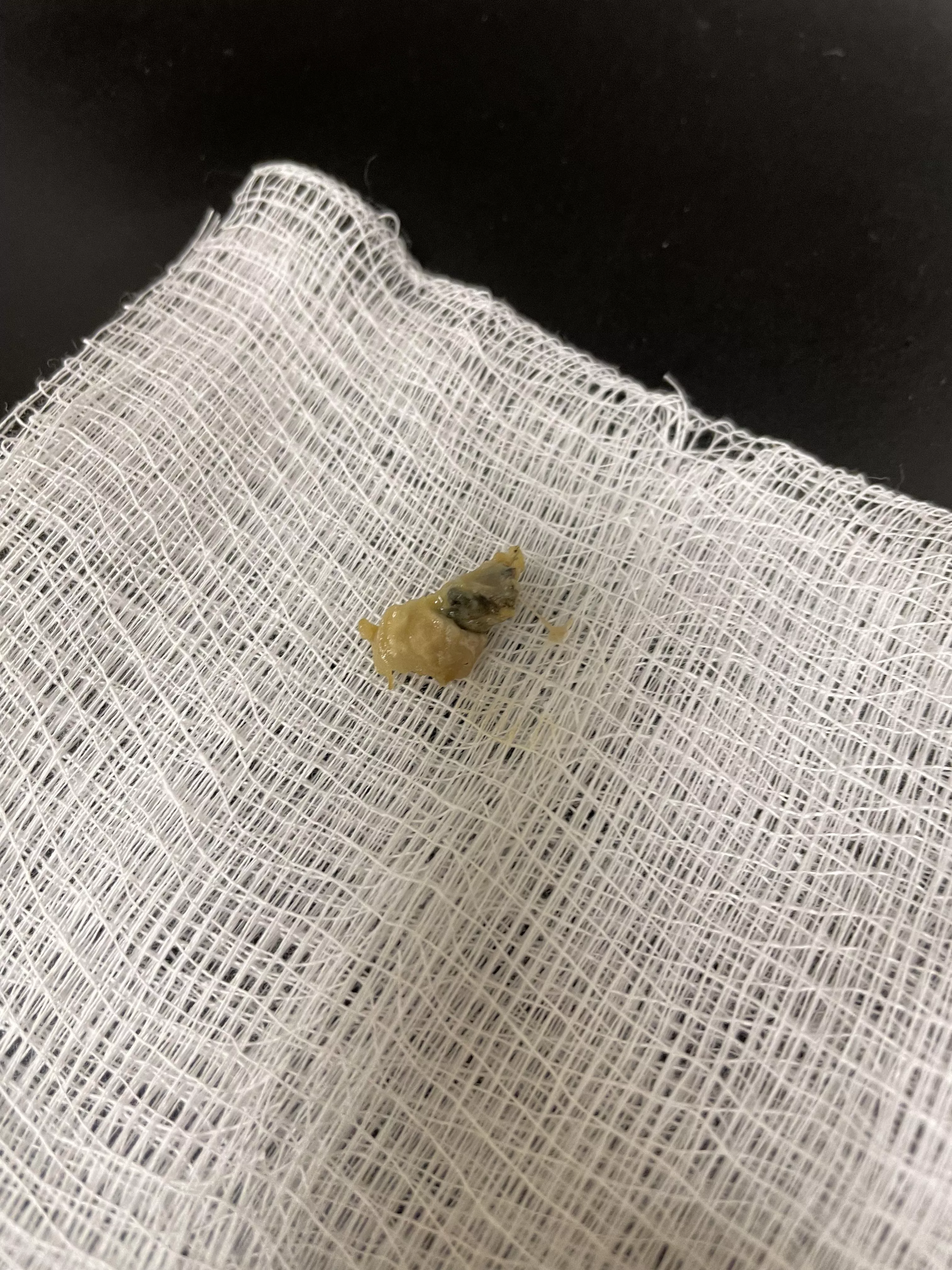 Fungal and pus plug extracted from my ear. Infections suck.