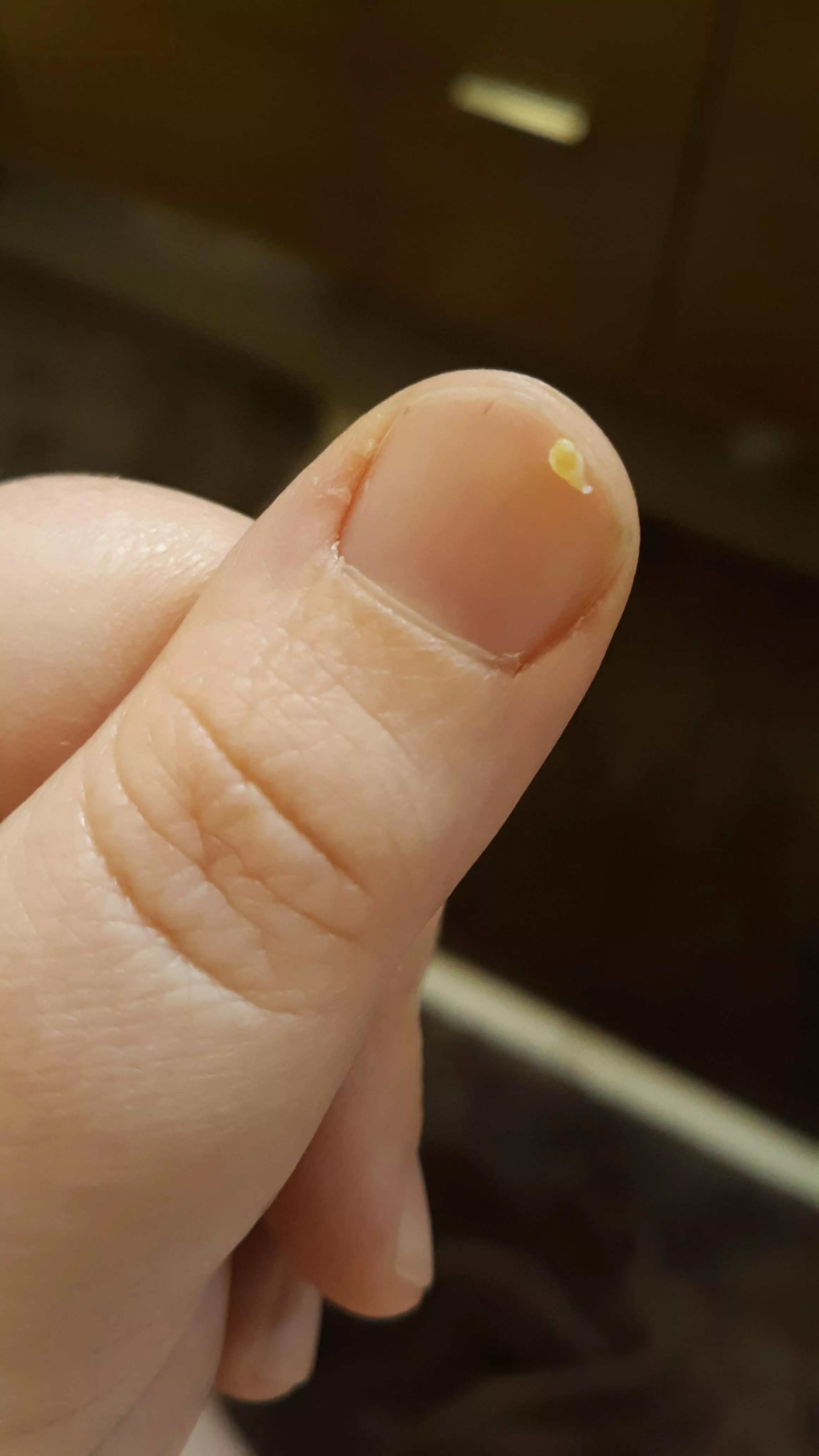 Got this big one out of my tummy the other day!