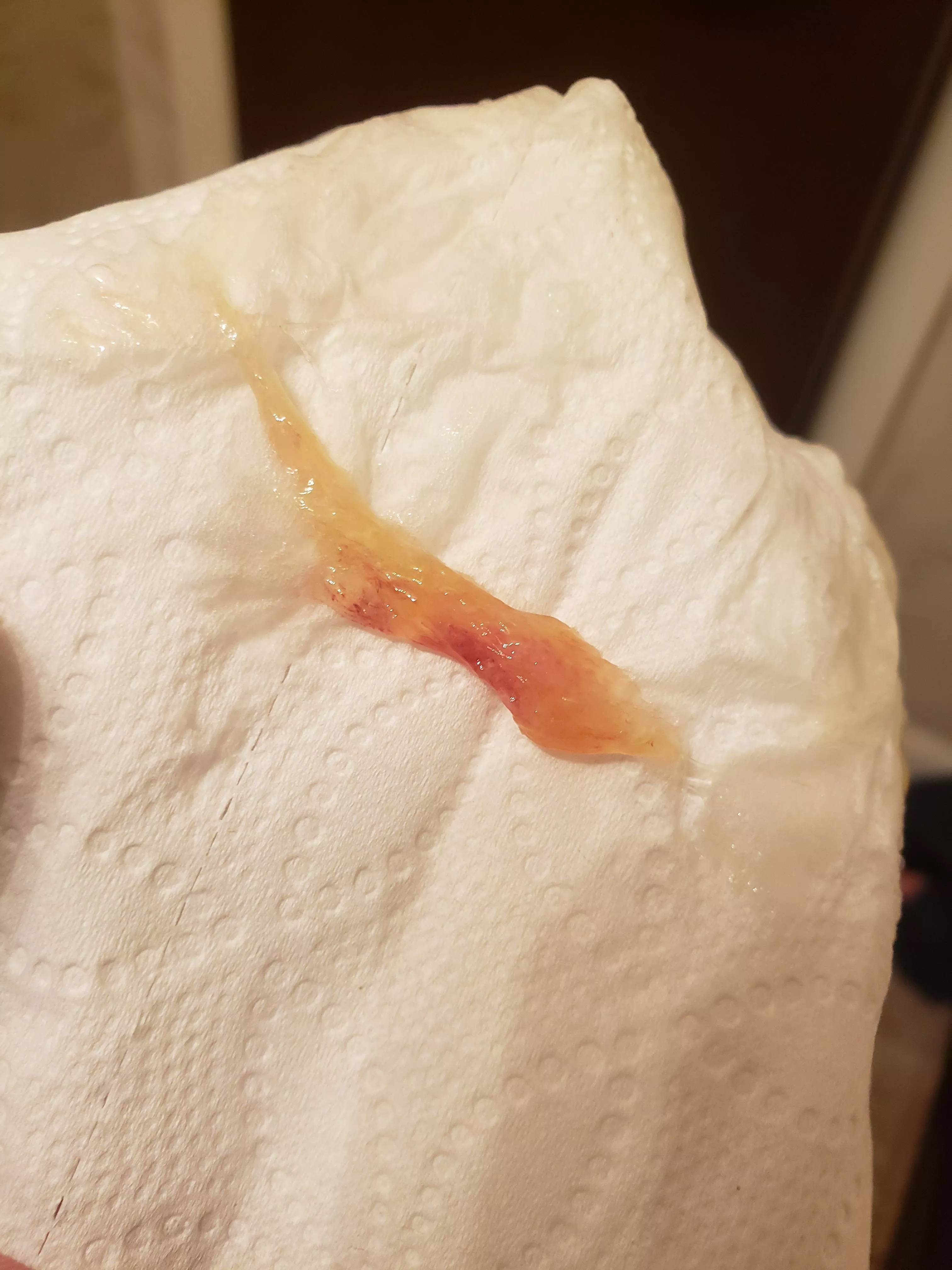 Had this come out of my sinus today