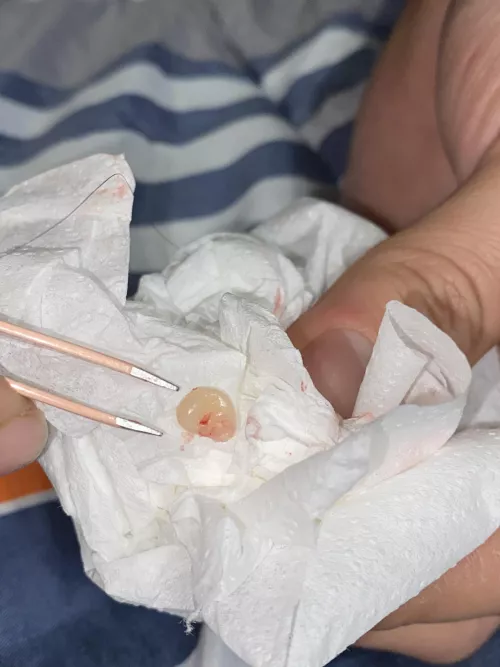 Have had this annoying cyst on my head for years. Finally couldn’t take it anymore and bf saved me a derm trip. First couple squeezes had pus/goop and then finally the pocket poked out. Sorry no video of the corn coming out. But boy does it feel better