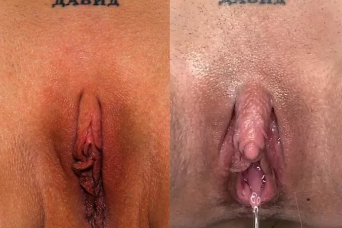 I always love sharing before & after pics of my big clit enlargement. Look how far Iโve cum! ๐คค๐ I always love sharing before & after pics of my big clit enlargement. Look how far Iโve cum! ๐คค๐