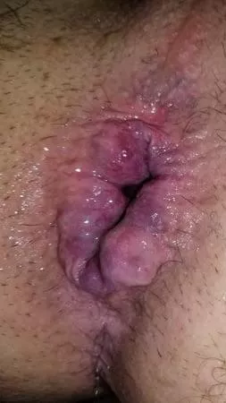 I got destroyed this weekend. This is two days after the event.