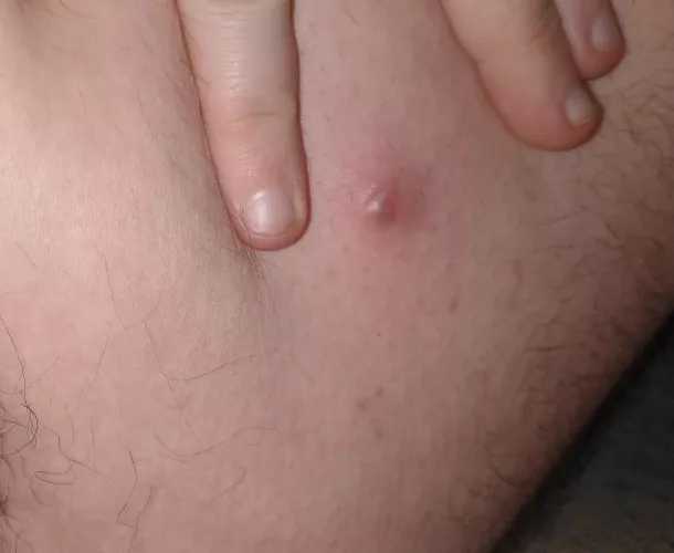 I just found a giant unpoppable zit on my inner thigh.. it's absolutely giant and mainly under the surface. very tempted to cut it open but am trying to stop myself
