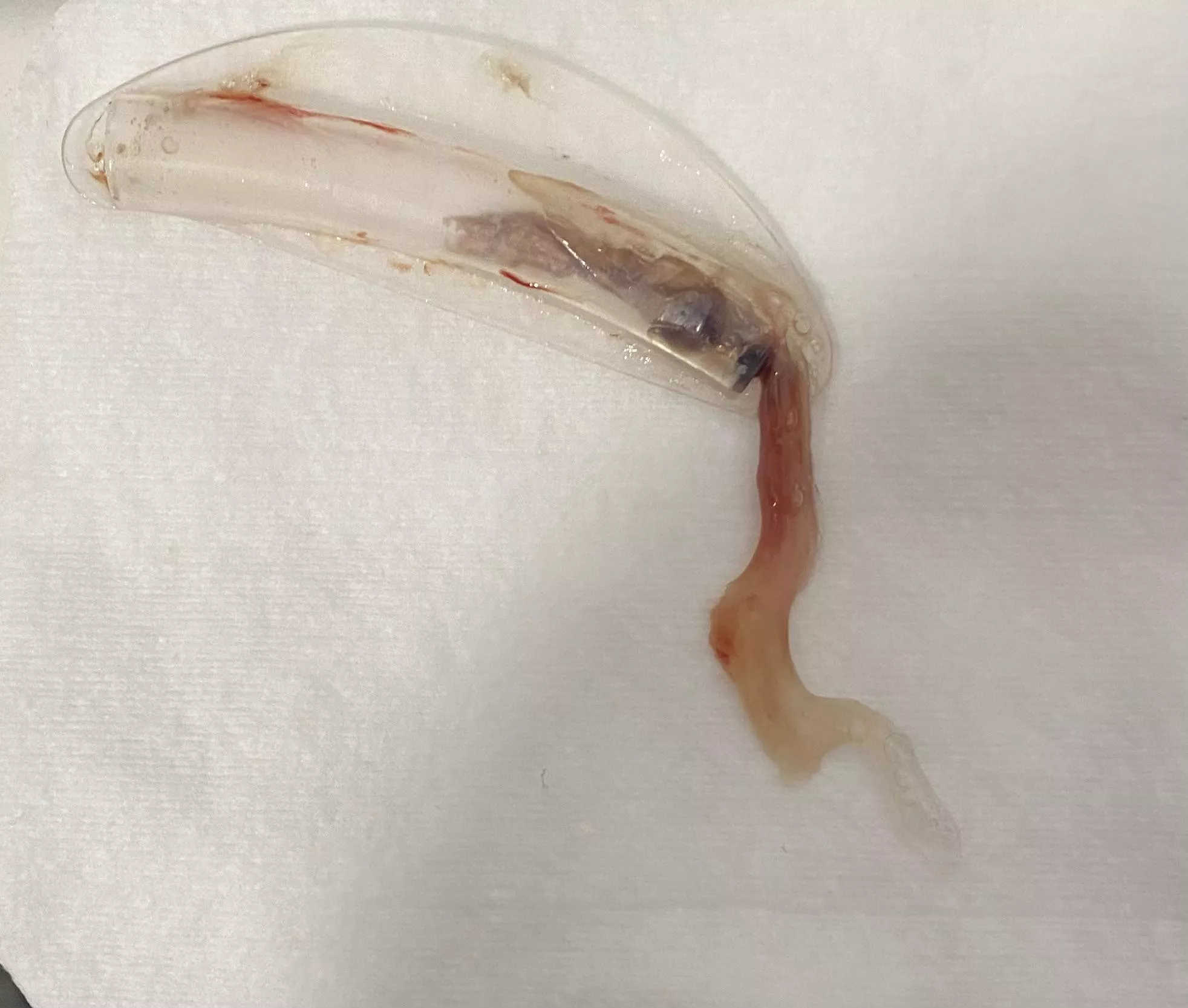 I recently had a septoplasty, it felt like I was pulling part of my brain out. I recently had a septoplasty, it felt like I was pulling part of my brain out.