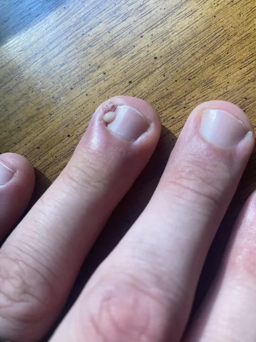 Ingrown fingernail. Hurts so bad I was shaking.