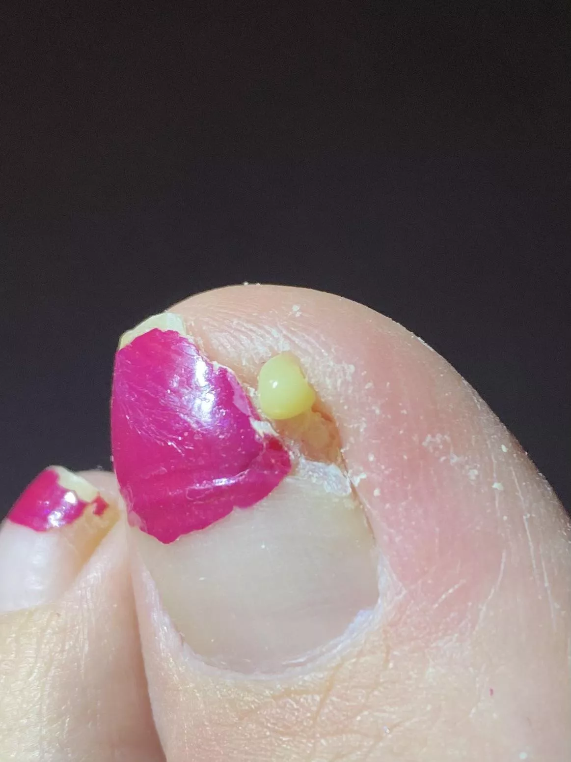 Ingrown toenail pus?