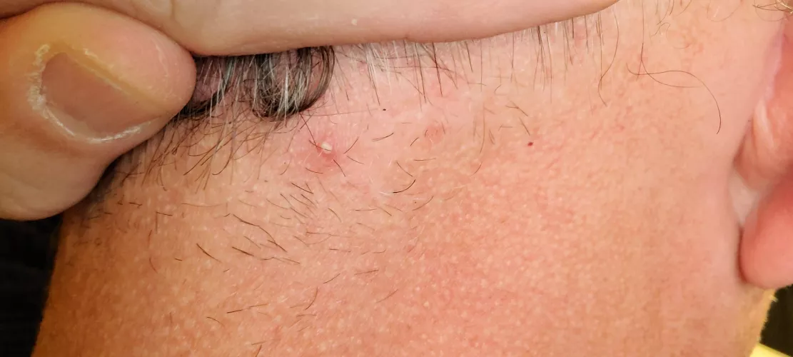 It's on the back of my neck, don't know how to capture