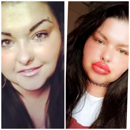 I've evolved !!! New lips yesterday another 1cc in ๐ I want more now ! I'm so greedy